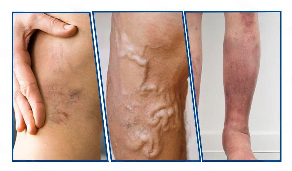 Healrize® Vénacélpont mikrotűs tapasz⚡Azonnali enyhülés hosszú távú eredmények