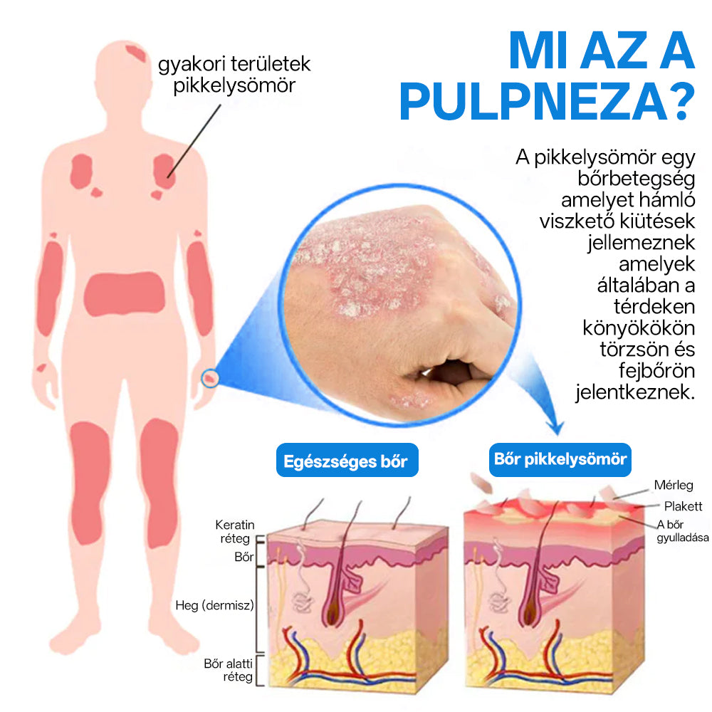 Hivatalos bolt: Zvoevo® Magnéziumos gyógynövényes spray pikkelysömörre ⚕️ MHRA tanúsítvánnyal (enyhíti a pikkelysömört, ekcémát, kezeli pattanásokat, szemölcsöket, javítja bakteriális fertőzéseket)
