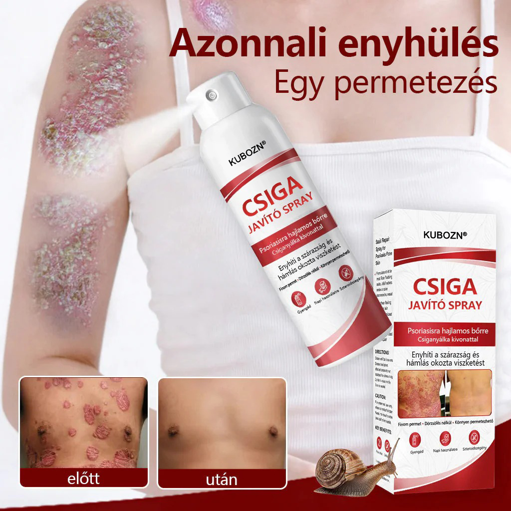 KUBOZN®  csigahéjas spray viszkető, hámló pikkelysömörös bőrre