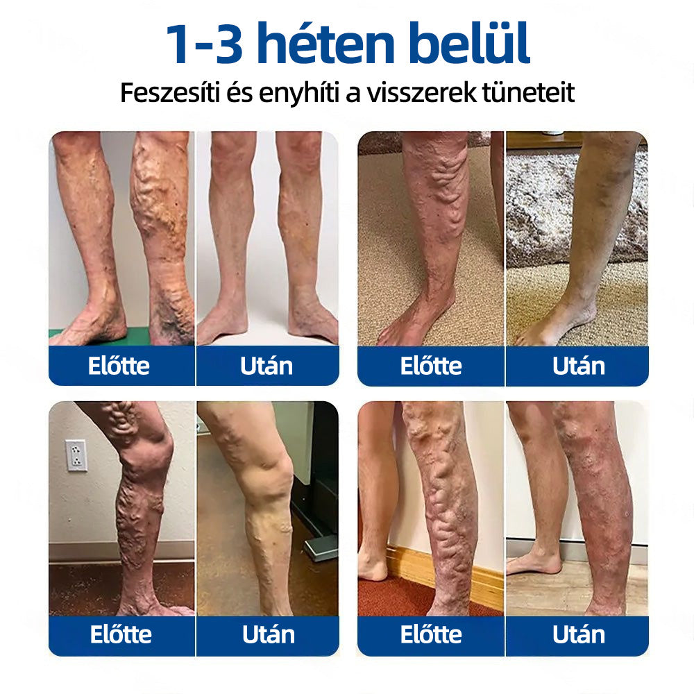 Healrize® Vénacélpont mikrotűs tapasz⚡Azonnali enyhülés hosszú távú eredmények
