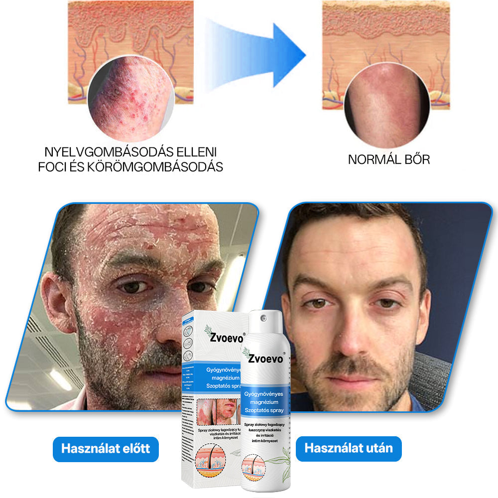 Hivatalos bolt: Zvoevo® Magnéziumos gyógynövényes spray pikkelysömörre ⚕️ MHRA tanúsítvánnyal (enyhíti a pikkelysömört, ekcémát, kezeli pattanásokat, szemölcsöket, javítja bakteriális fertőzéseket)