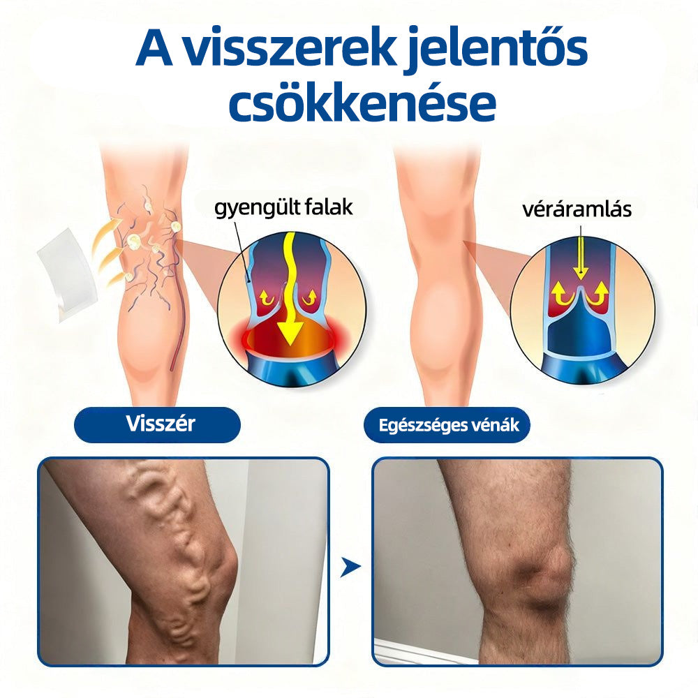Healrize® Vénacélpont mikrotűs tapasz⚡Azonnali enyhülés hosszú távú eredmények