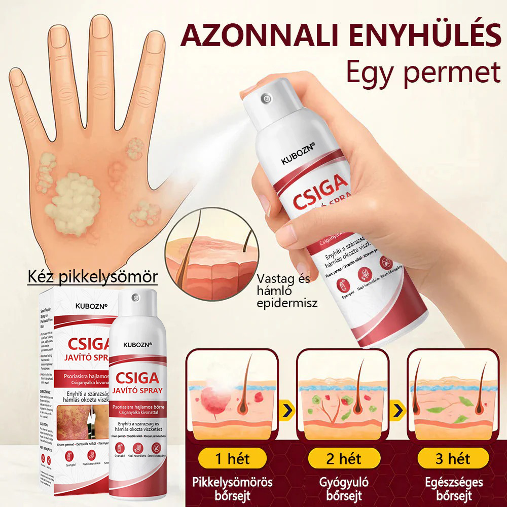 KUBOZN®  csigahéjas spray viszkető, hámló pikkelysömörös bőrre