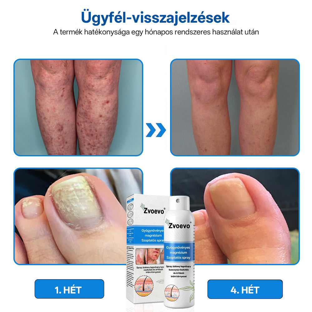 Hivatalos bolt: Zvoevo® Magnéziumos gyógynövényes spray pikkelysömörre ⚕️ MHRA tanúsítvánnyal (enyhíti a pikkelysömört, ekcémát, kezeli pattanásokat, szemölcsöket, javítja bakteriális fertőzéseket)