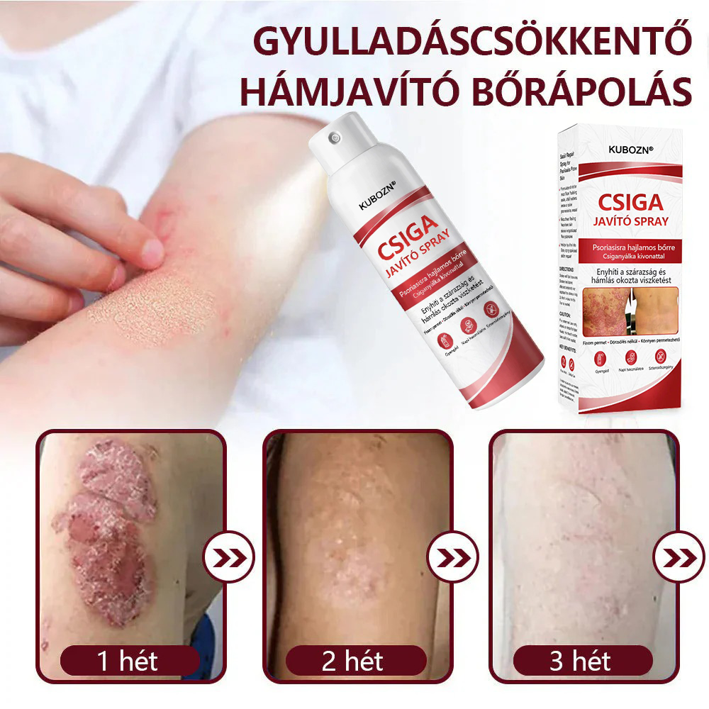 KUBOZN®  csigahéjas spray viszkető, hámló pikkelysömörös bőrre