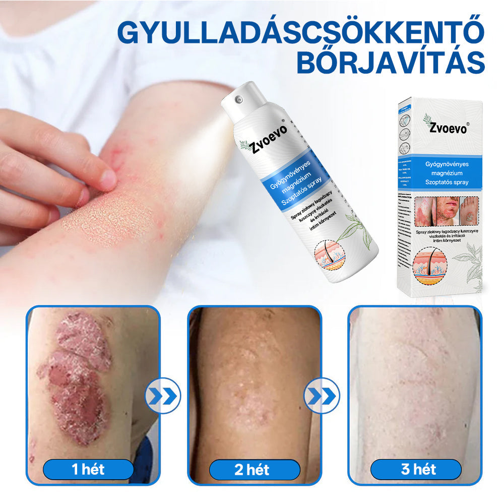 Hivatalos bolt: Zvoevo® Magnéziumos gyógynövényes spray pikkelysömörre ⚕️ MHRA tanúsítvánnyal (enyhíti a pikkelysömört, ekcémát, kezeli pattanásokat, szemölcsöket, javítja bakteriális fertőzéseket)